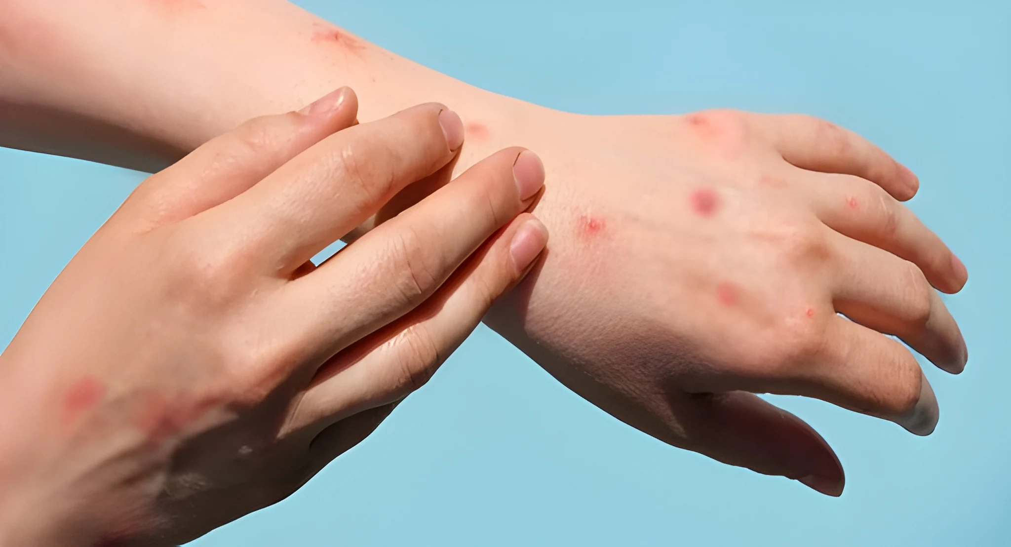 karachi-reports-new-monkeypox-case-city-total-reaches-14