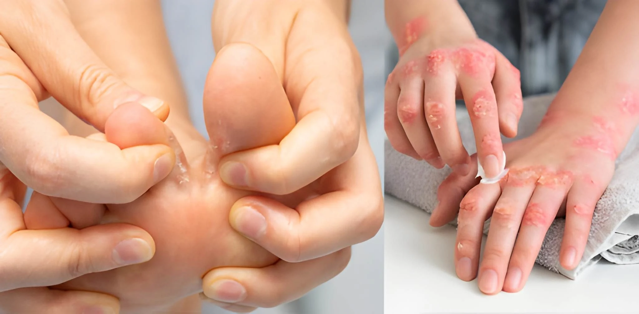 بارشوں-میں-انگلیوں-کے-درمیان-خارش-کی-اصل-وجہ-کیا-ہے؟