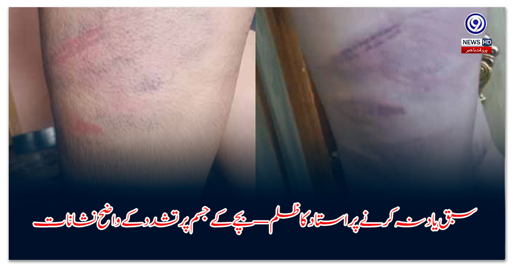 سبق-یاد-نہ-کرنے-پر-استاد-کا-ظلم-—-بچے-کے-جسم-پر-تشدد-کے-واضح-نشانات