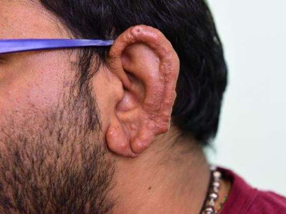 کوڑھ