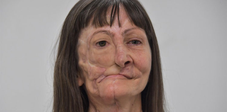 prosthesis-gives-cancer-survivor-a-new-face