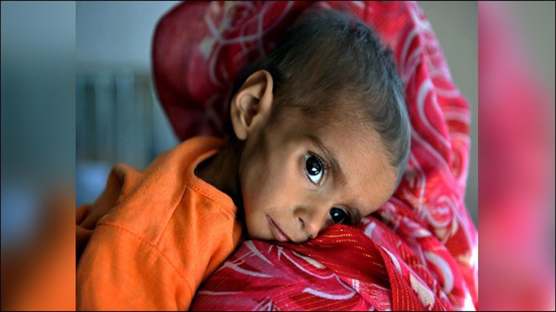 six-more-toddlers-fall-prey-to-malnutrition-in-tharparkar